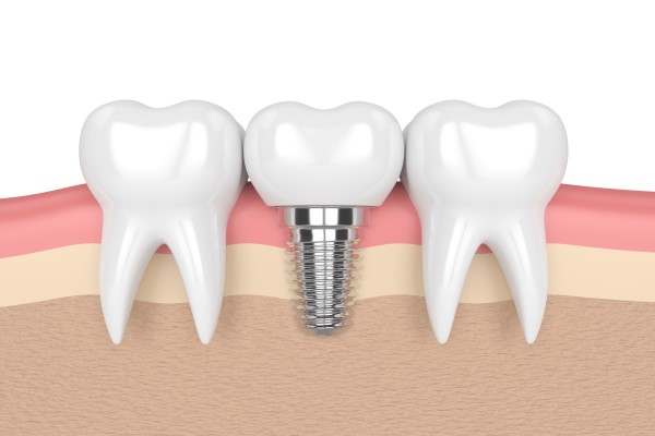 Dental Implants